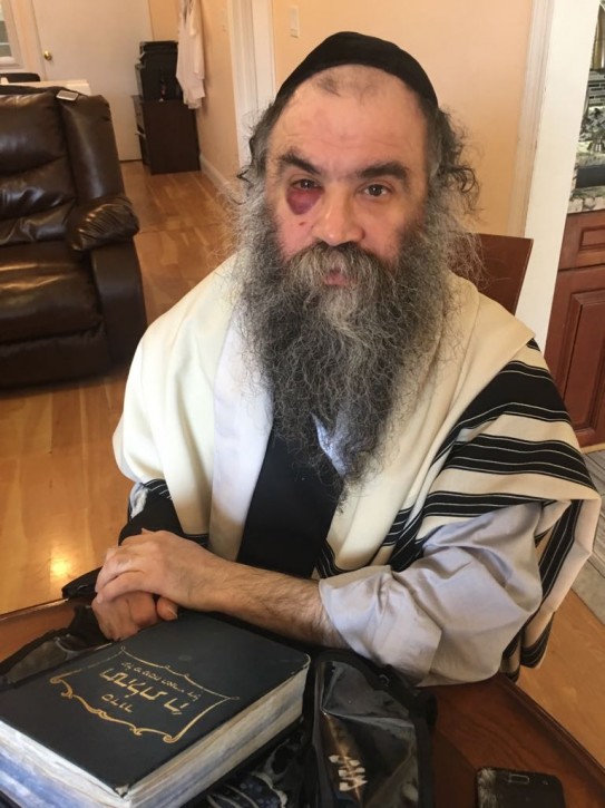 Menachem Moskowitz seen with a black eye a day after the attack